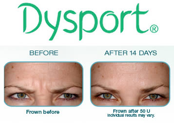 DrySport Before and After