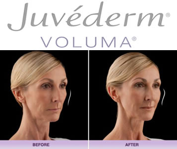 Juvederm Voluma Before and After