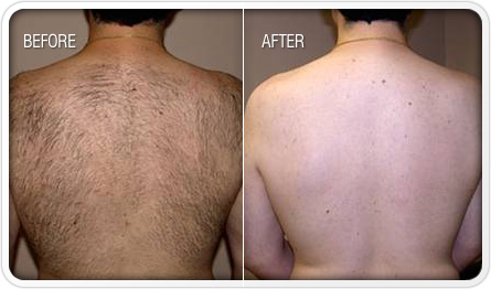 Laser Hair Removal 2